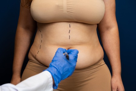 Abdominoplasty Hyderabad - Inform Clinics