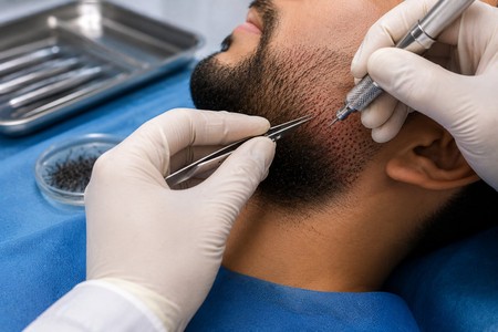 Beard Transplant Hyderabad