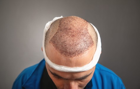 FUE Hair Transplant Hyderabad