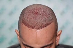 Advanced robotic hair transplant Hyderabad Logo
