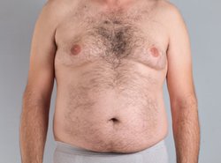 Gland-Only Gynecomastia Surgery in Hyderabad Logo