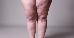 Lipedema Liposuction in Hyderabad Logo