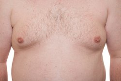 Massive gynaecomastia correction in Hyderabad Logo