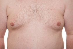 Massive gynaecomastia surgery in Hyderabad Logo