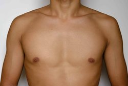 minimal scar male breast reduction in Hyderabad Logo