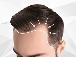 Revision hair transplant Hyderabad Logo