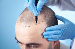 Robotic hair transplant Hyderabad Logo