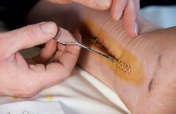 Suture removal at home in Chennai Logo