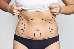 Top liposuction surgeon in Hyderabad Logo