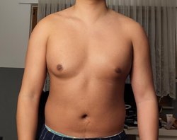 Unilateral gynaecomastia correction in Hyderabad Logo