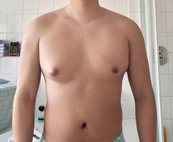 unilateral gynaecomastia in Hyderabad Logo